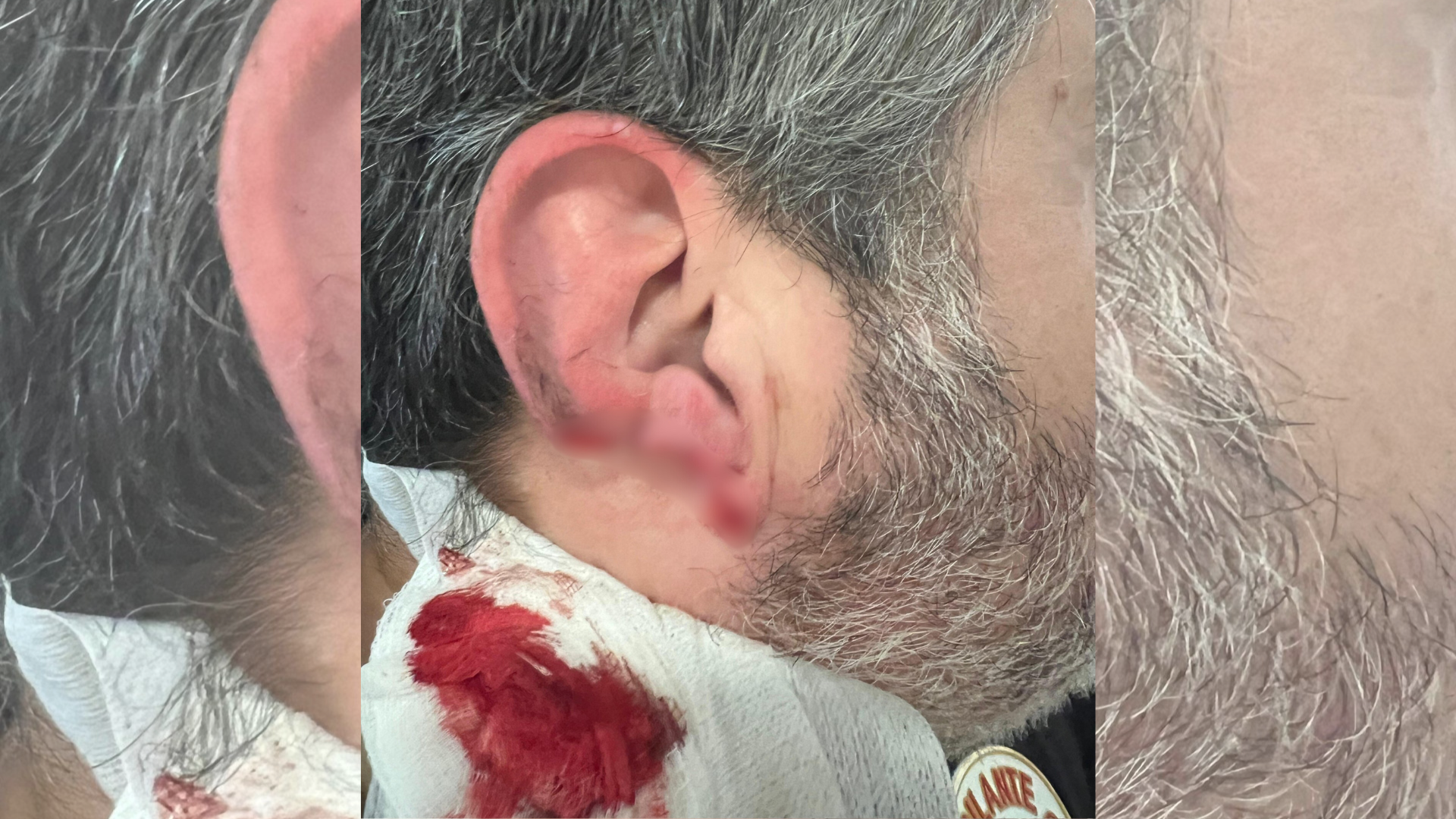 Prosegur, denunciada tras perder un vixiante de seguridade parte da orella nunha agresión no Hospital de Oza